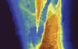 Ngã - kẻ thù của người cao tuổi